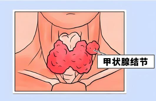 国企入职体检甲状腺检查，很严格吗？