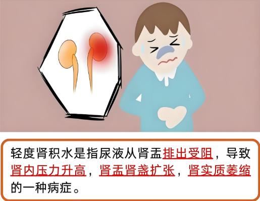 肾积水会影响公务员体检结果吗？标准是怎么样的？