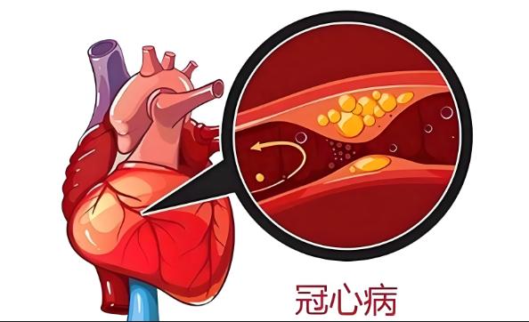 公务员体检攻略：冠心病会影响公务员体检结果吗？