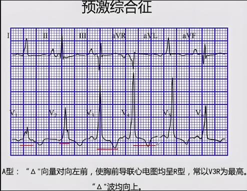 预激综合征会影响公务员体检结果吗？教你如何顺利通过体检的秘密