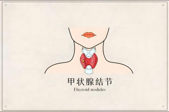 揭秘甲状腺结节是如何通过公务员体检的？