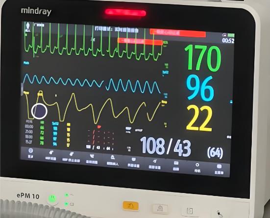 入职体检心电图显示ST改变，入职体检结果不合格怎么办？